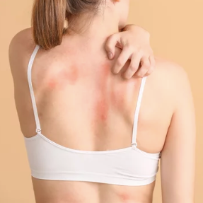 Eczema
